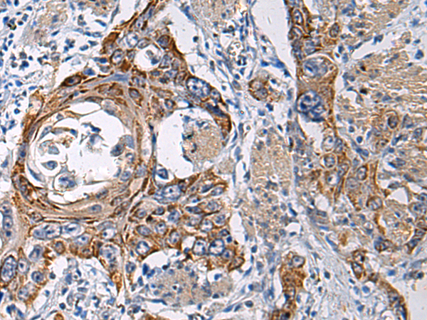 Immunohistochemistry of paraffin-embedded Human esophagus cancer tissue  using RITA1 Polyclonal Antibody at dilution of 1:60(×200)