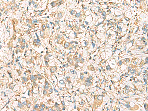 Immunohistochemistry of paraffin-embedded Human liver cancer tissue  using IDS Polyclonal Antibody at dilution of 1:60(×200)