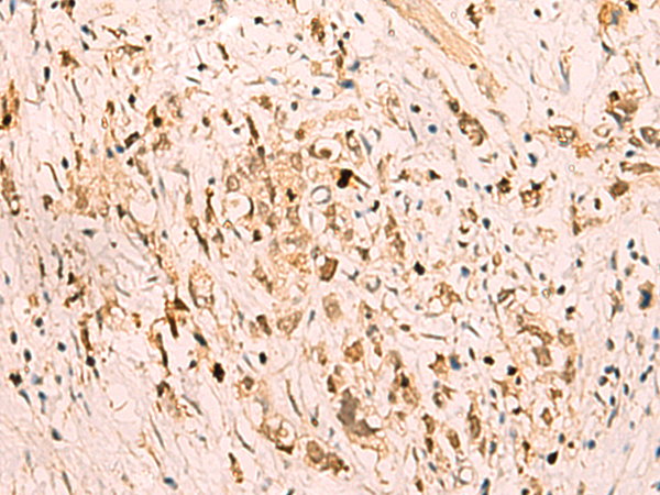 Immunohistochemistry of paraffin-embedded Human gastric cancer tissue  using SGTA Polyclonal Antibody at dilution of 1:75(×200)