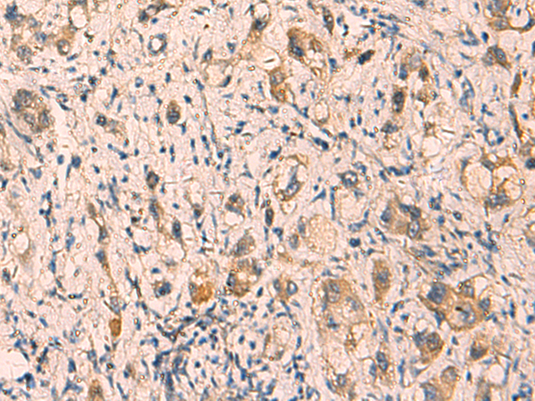 Immunohistochemistry of paraffin-embedded Human liver cancer tissue  using CRYM Polyclonal Antibody at dilution of 1:65(×200)