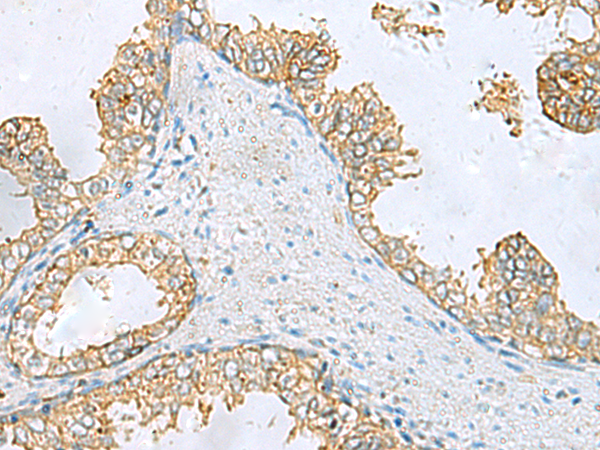 Immunohistochemistry of paraffin-embedded Human prost ate cancer tissue  using EPCAM Polyclonal Antibody at dilution of 1:60(×200)