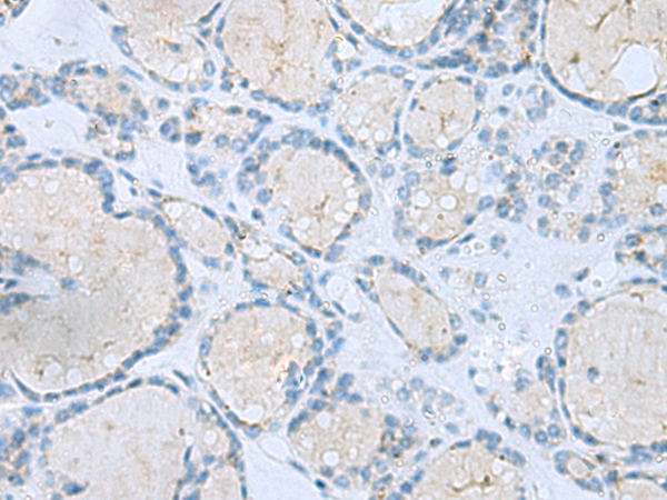 Immunohistochemistry of paraffin-embedded Human thyroid cancer tissue  using MSI2 Polyclonal Antibody at dilution of 1:60(×200)