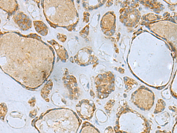 Immunohistochemistry of paraffin-embedded Human thyroid cancer tissue  using ENKD1 Polyclonal Antibody at dilution of 1:80(×200)