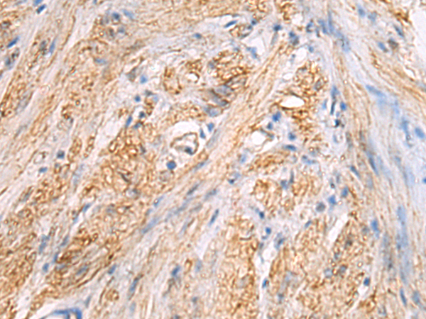 Immunohistochemistry of paraffin-embedded Human gastric cancer tissue  using TMOD3 Polyclonal Antibody at dilution of 1:70(×200)