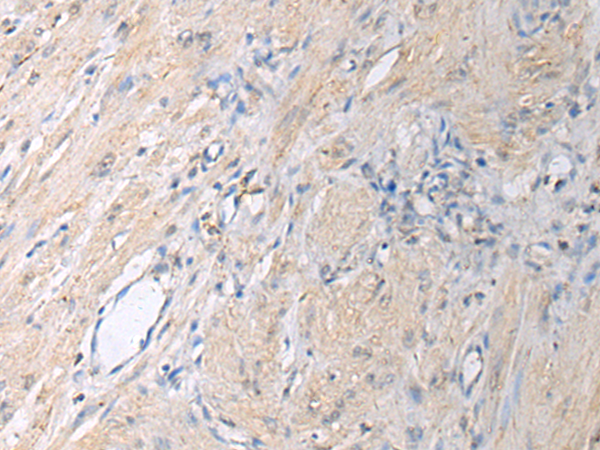 Immunohistochemistry of paraffin-embedded Human gastric cancer tissue  using GNAI1 Polyclonal Antibody at dilution of 1:130(×200)