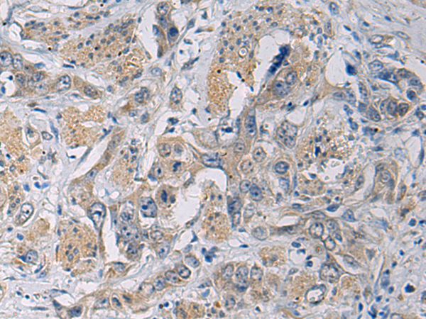Immunohistochemistry of paraffin-embedded Human esophagus cancer tissue  using CYTIP Polyclonal Antibody at dilution of 1:50(×200)