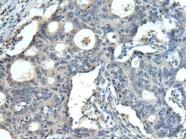 Immunohistochemistry of paraffin-embedded Human colorectal cancer tissue  using FCRLA Polyclonal Antibody at dilution of 1:90(×200)