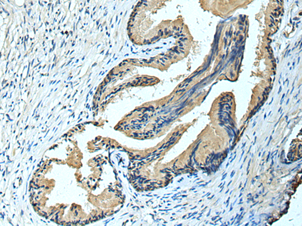 Immunohistochemistry of paraffin-embedded Human prost ate cancer tissue  using FCRLA Polyclonal Antibody at dilution of 1:90(×200)