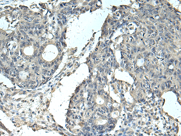Immunohistochemistry of paraffin-embedded Human colorectal cancer tissue  using SLC35F6 Polyclonal Antibody at dilution of 1:95(×200)