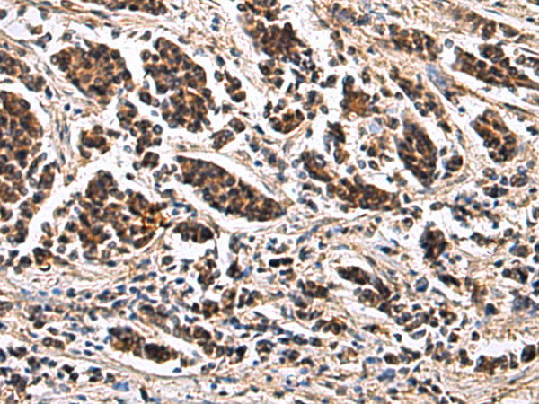 Immunohistochemistry of paraffin-embedded Human breast cancer tissue  using ARPC1B Polyclonal Antibody at dilution of 1:65(×200)