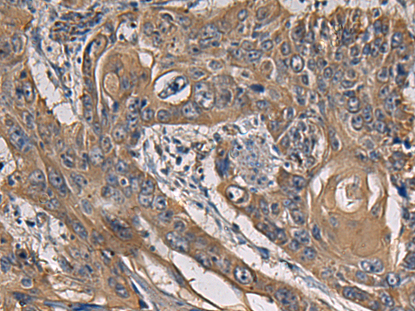 Immunohistochemistry of paraffin-embedded Human esophagus cancer tissue  using CCNI Polyclonal Antibody at dilution of 1:65(×200)