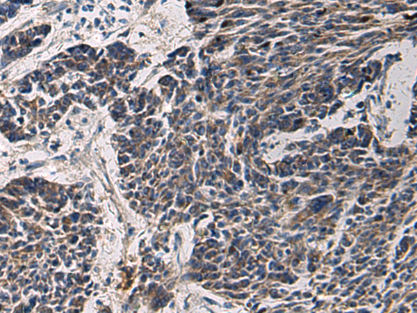 Immunohistochemistry of paraffin-embedded Human colorectal cancer tissue  using CCNI Polyclonal Antibody at dilution of 1:65(×200)