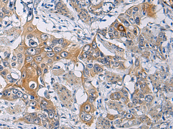 Immunohistochemistry of paraffin-embedded Human esophagus cancer tissue  using KCNJ10 Polyclonal Antibody at dilution of 1:60(×200)