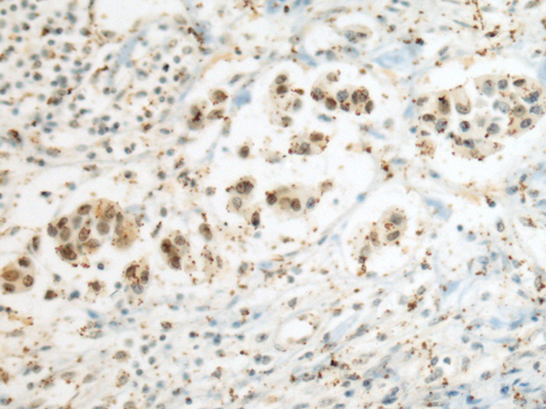 Immunohistochemistry of paraffin-embedded Human breast cancer tissue  using SEPHS1 Polyclonal Antibody at dilution of 1:80(×200)