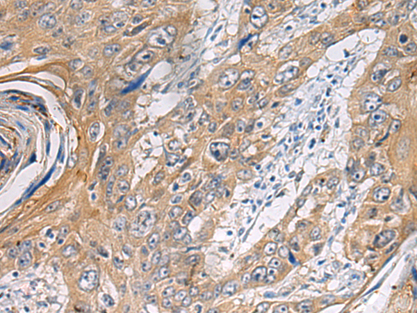 Immunohistochemistry of paraffin-embedded Human esophagus cancer tissue  using PA2G4 Polyclonal Antibody at dilution of 1:60(×200)