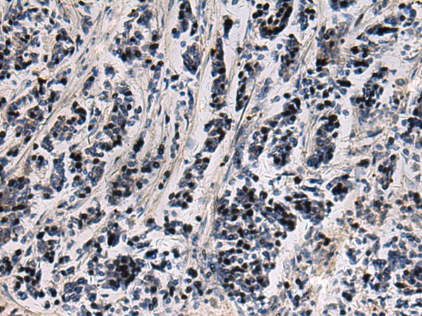 Immunohistochemistry of paraffin-embedded Human breast cancer tissue  using SNIP1 Polyclonal Antibody at dilution of 1:80(×200)