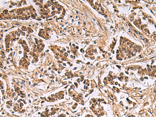 Immunohistochemistry of paraffin-embedded Human breast cancer tissue  using DNA2 Polyclonal Antibody at dilution of 1:40(×200)