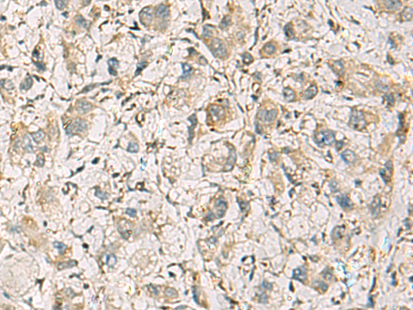 Immunohistochemistry of paraffin-embedded Human liver cancer tissue  using CMTM1 Polyclonal Antibody at dilution of 1:40(×200)