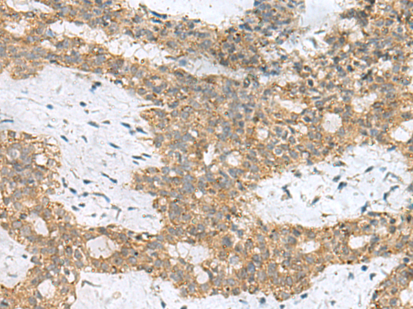 Immunohistochemistry of paraffin-embedded Human breast cancer tissue  using SKI Polyclonal Antibody at dilution of 1:70(×200)