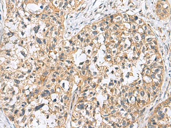 Immunohistochemistry of paraffin-embedded Human esophagus cancer tissue  using SKI Polyclonal Antibody at dilution of 1:70(×200)