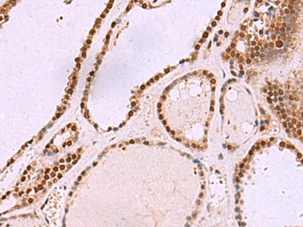 Immunohistochemistry of paraffin-embedded Human thyroid cancer tissue  using CUL4A Polyclonal Antibody at dilution of 1:55(×200)