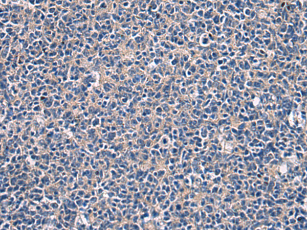 Immunohistochemistry of paraffin-embedded Human tonsil tissue  using LAMP3 Polyclonal Antibody at dilution of 1:30(×200)