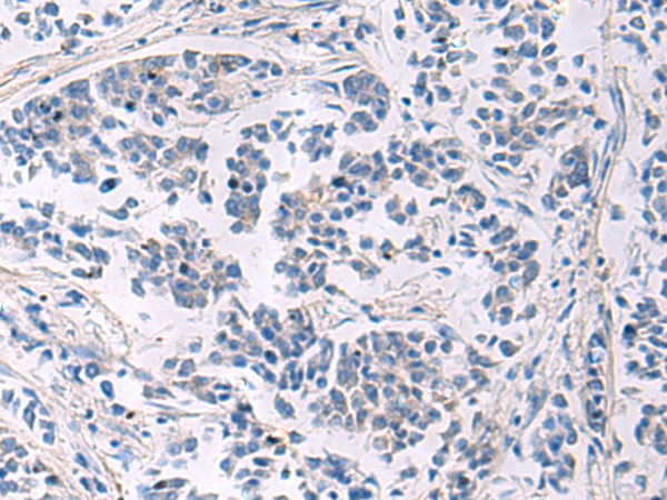 Immunohistochemistry of paraffin-embedded Human breast cancer tissue  using LAMP3 Polyclonal Antibody at dilution of 1:30(×200)