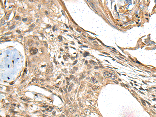 Immunohistochemistry of paraffin-embedded Human esophagus cancer tissue  using MAPK4 Polyclonal Antibody at dilution of 1:35(×200)