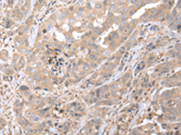 Immunohistochemistry of paraffin-embedded Human breast cancer tissue  using PPBP Polyclonal Antibody at dilution of 1:35(×200)