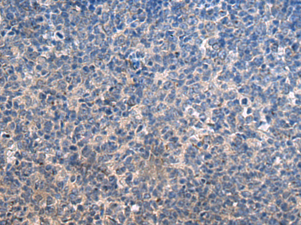 Immunohistochemistry of paraffin-embedded Human tonsil tissue  using HSPA5 Polyclonal Antibody at dilution of 1:35(×200)