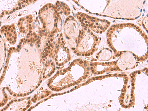 Immunohistochemistry of paraffin-embedded Human thyroid cancer tissue  using MCMBP Polyclonal Antibody at dilution of 1:35(×200)