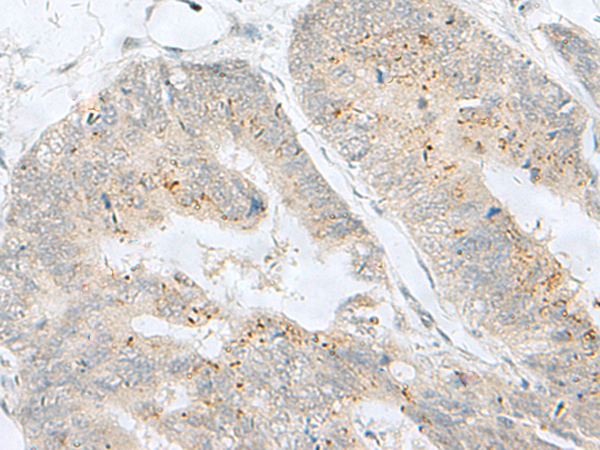 Immunohistochemistry of paraffin-embedded Human colorectal cancer tissue  using MLNR Polyclonal Antibody at dilution of 1:35(×200)