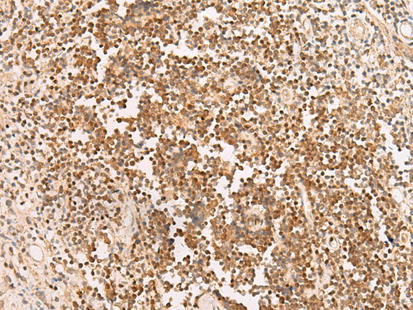 Immunohistochemistry of paraffin-embedded Human prost at e cancer tissue  using PAX5 Polyclonal Antibody at dilution of 1:30(×200)