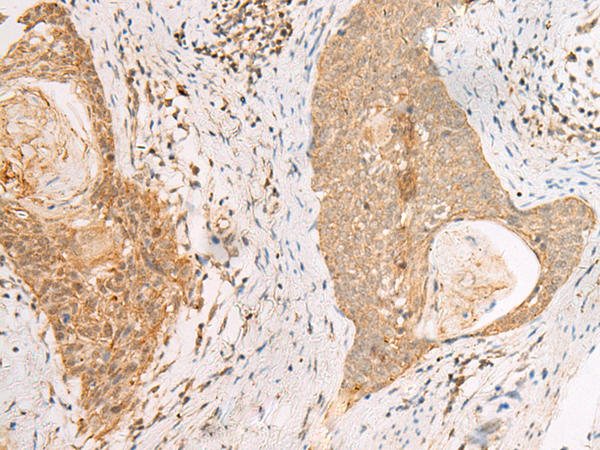 Immunohistochemistry of paraffin-embedded Human esophagus cancer tissue  using PAX5 Polyclonal Antibody at dilution of 1:30(×200)