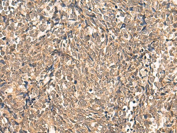 Immunohistochemistry of paraffin-embedded Human lung cancer tissue  using HNF1A Polyclonal Antibody at dilution of 1:50(×200)
