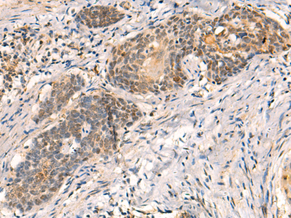 Immunohistochemistry of paraffin-embedded Human esophagus cancer tissue  using HNF1A Polyclonal Antibody at dilution of 1:50(×200)
