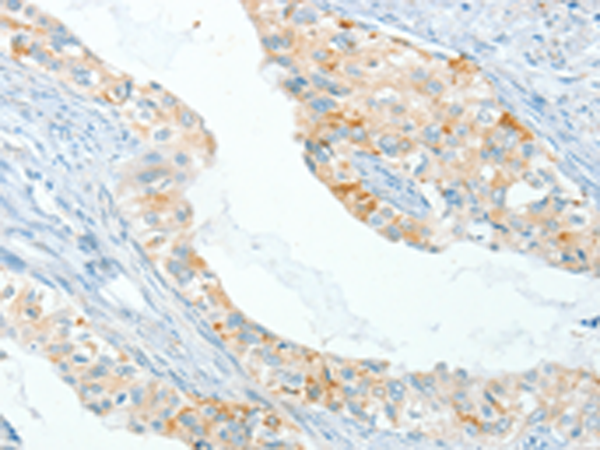 Immunohistochemistry of paraffin-embedded Human cervical cancer tissue  using APOL2 Polyclonal Antibody at dilution of 1:80(×200)