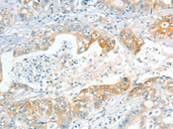 Immunohistochemistry of paraffin-embedded Human gastric cancer tissue  using APOL2 Polyclonal Antibody at dilution of 1:80(×200)