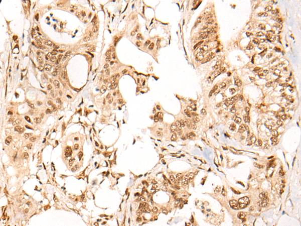 Immunohistochemistry of paraffin-embedded Human colorectal cancer tissue  using ARID1B Polyclonal Antibody at dilution of 1:40(×200)