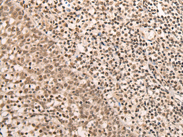 Immunohistochemistry of paraffin-embedded Human tonsil tissue  using ARID1B Polyclonal Antibody at dilution of 1:40(×200)
