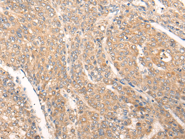 Immunohistochemistry of paraffin-embedded Human liver cancer tissue  using PIAS3 Polyclonal Antibody at dilution of 1:40(×200)