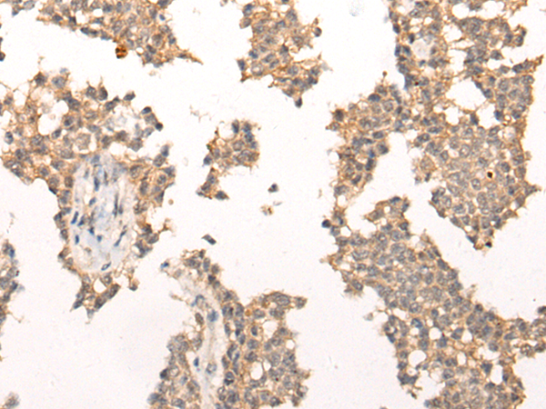 Immunohistochemistry of paraffin-embedded Human ovarian cancer tissue  using PIAS3 Polyclonal Antibody at dilution of 1:40(×200)
