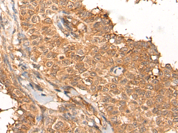 Immunohistochemistry of paraffin-embedded Human ovarian cancer tissue  using NRG2 Polyclonal Antibody at dilution of 1:65(×200)