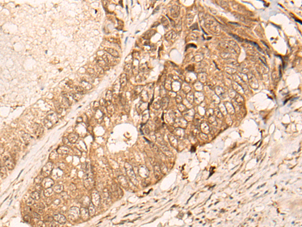Immunohistochemistry of paraffin-embedded Human colorectal cancer tissue  using HIPK3 Polyclonal Antibody at dilution of 1:60(×200)