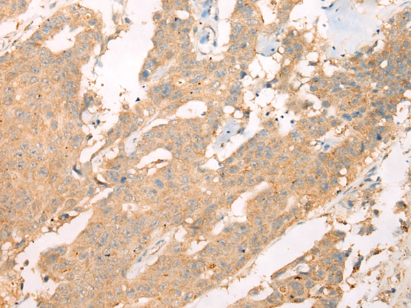 Immunohistochemistry of paraffin-embedded Human colorectal cancer tissue  using ASIC3 Polyclonal Antibody at dilution of 1:40(×200)