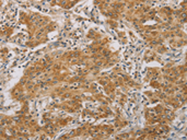 Immunohistochemistry of paraffin-embedded Human gasrtic cancer tissue  using CDKN2A Polyclonal Antibody at dilution of 1:50(×200)