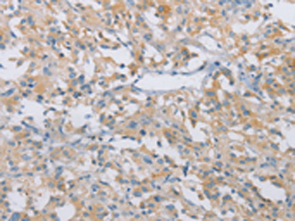 Immunohistochemistry of paraffin-embedded Human thyroid cancer tissue  using CDKN2A Polyclonal Antibody at dilution of 1:50(×200)