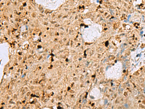 Immunohistochemistry of paraffin-embedded Human ovarian cancer tissue  using MAF Polyclonal Antibody at dilution of 1:25(×200)