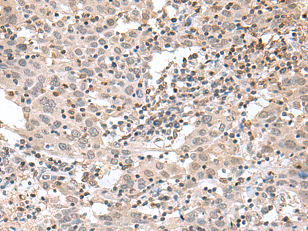 Immunohistochemistry of paraffin-embedded Human cervical cancer tissue  using TDP2 Polyclonal Antibody at dilution of 1:75(×200)