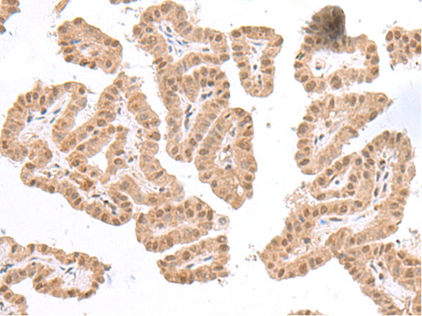 Immunohistochemistry of paraffin-embedded Human thyroid cancer tissue  using TDP2 Polyclonal Antibody at dilution of 1:75(×200)